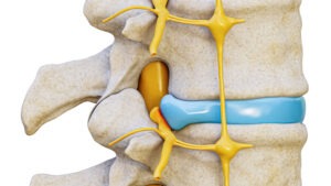 3D Illustration eines Bandscheibenvorfalls mit Spinalvervkompression beim Hund